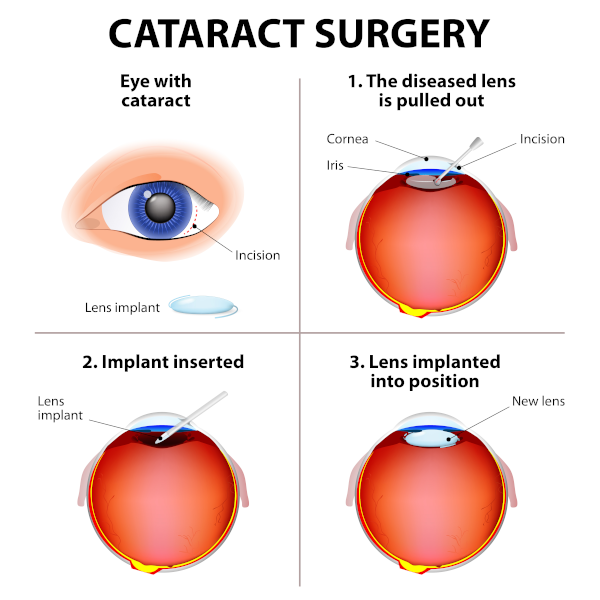 cataract