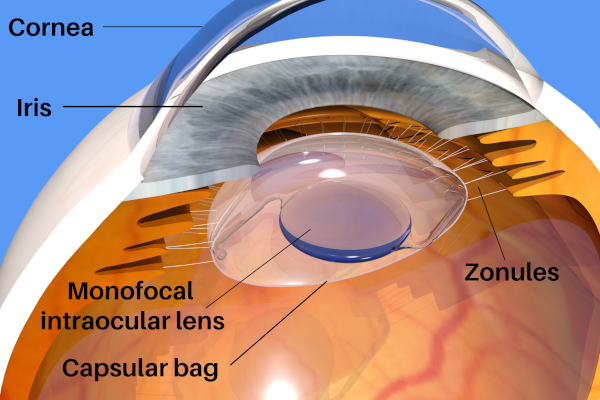 cataract