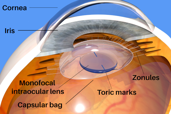 cataract surgery