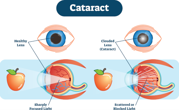 cataract