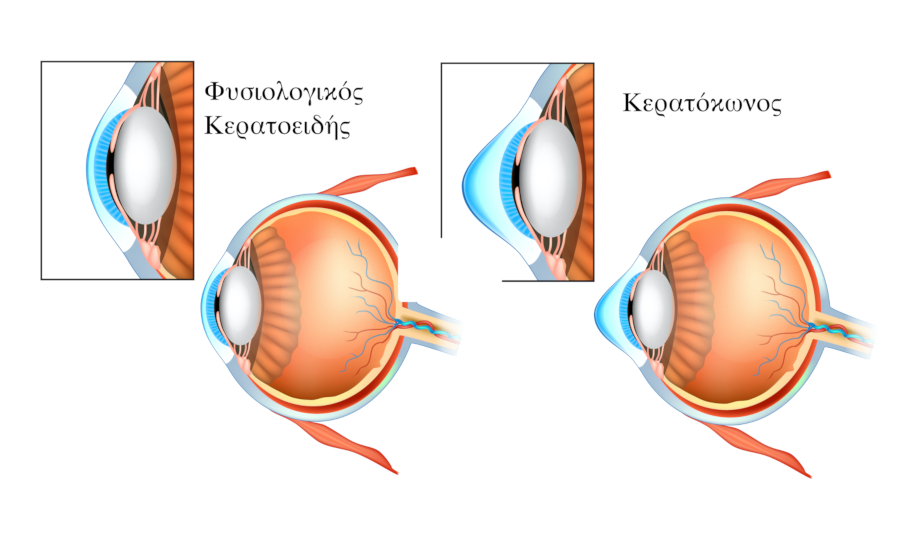 αντιμετωπιση κερατοκωνου