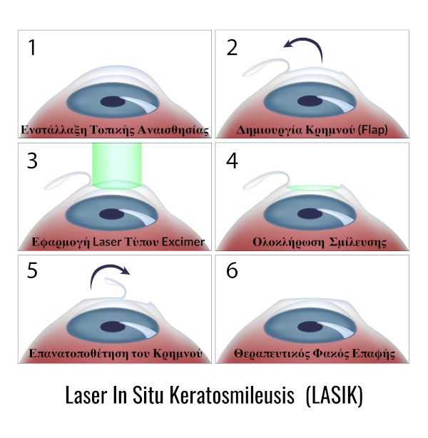διορθωση ορασης με λειζερ