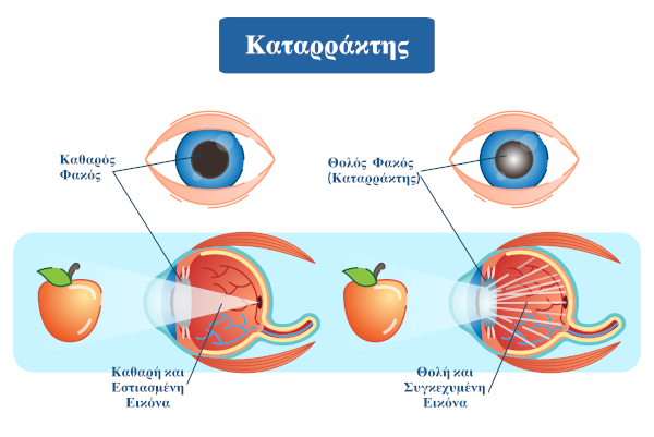 katarraktis