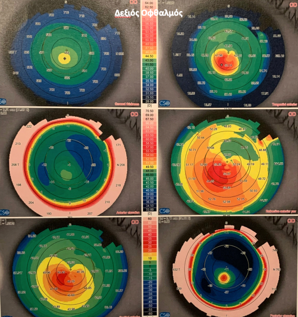 κερατοκωνος εκτασιες κερατοειδους