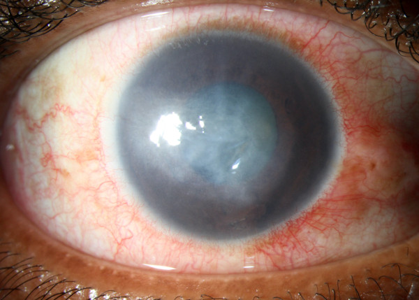 cornea transplantation