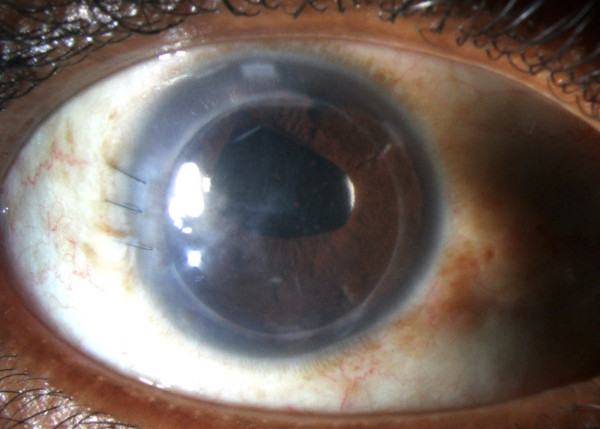 cornea transplantation