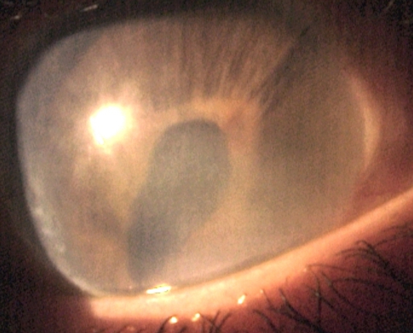 cornea transplantation