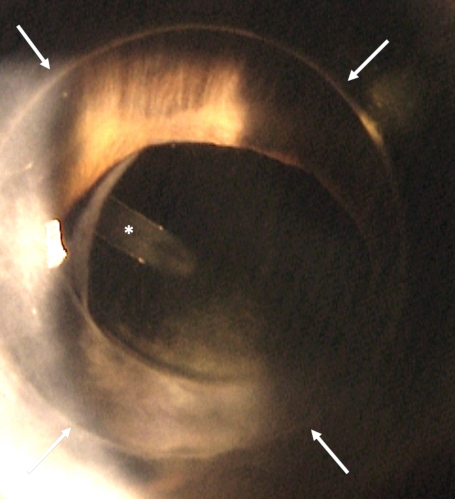 cornea transplantation