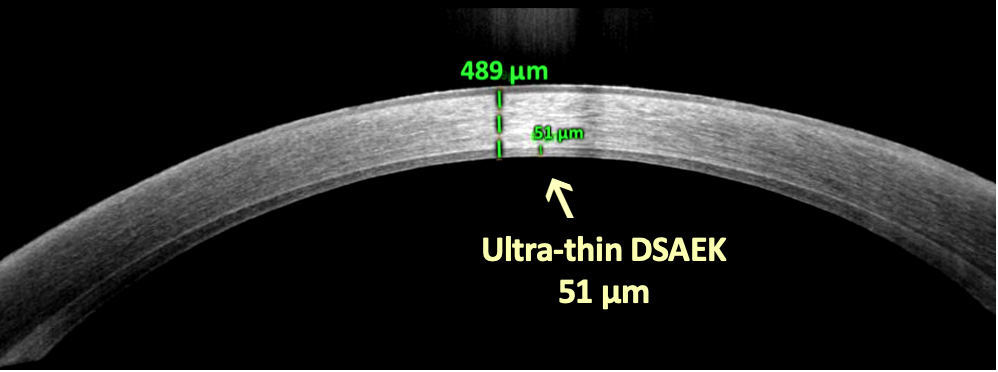 cornea transplantation