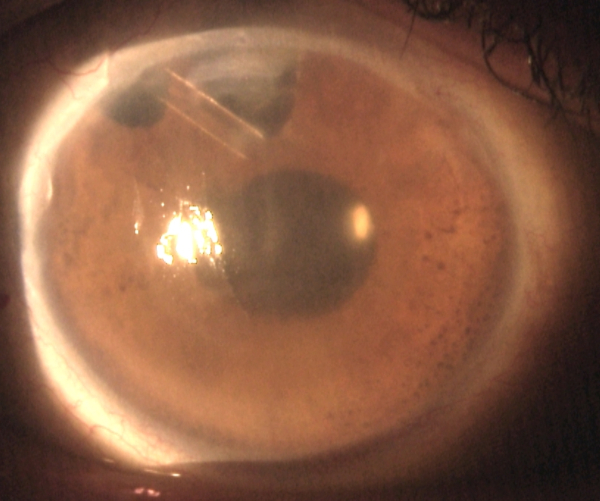 cornea transplantation