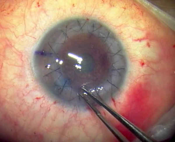 cornea transplantation