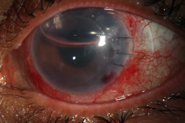 cornea transplantation