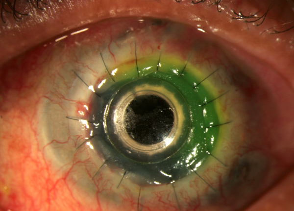 cornea transplantation