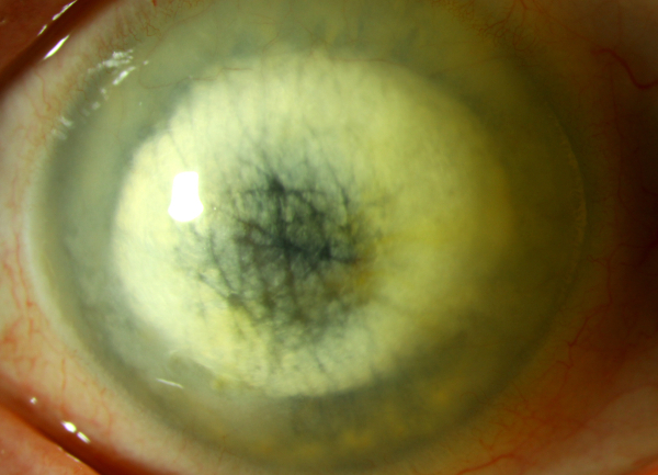 cornea transplantation