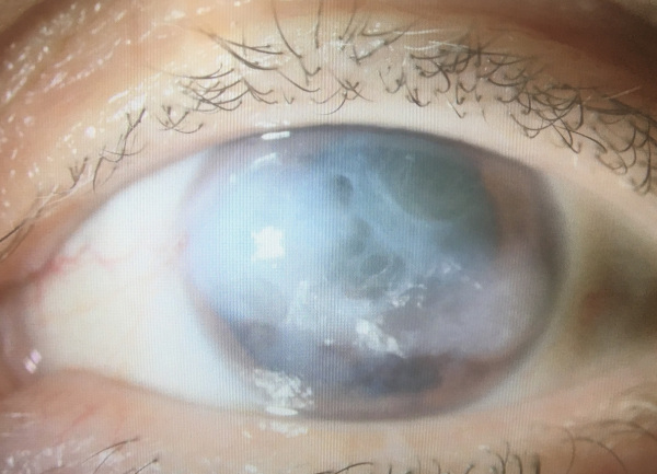 cornea transplantation