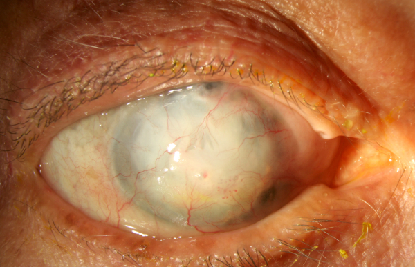 cornea transplantation