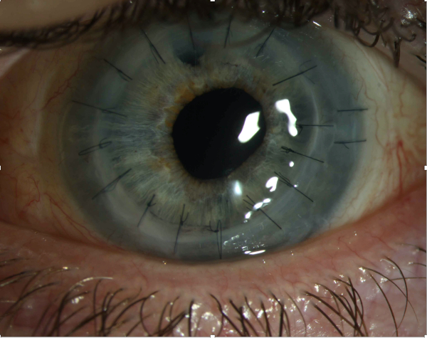 cornea transplantation