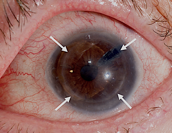 cornea transplantation