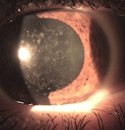 cornea transplantation