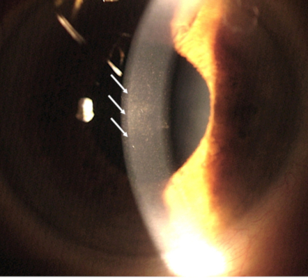 cornea transplantation